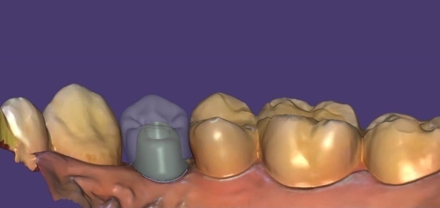 口腔内スキャナー　STLデータによるデジタル補綴物_コピー